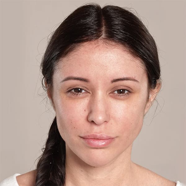 angelique-after-filler