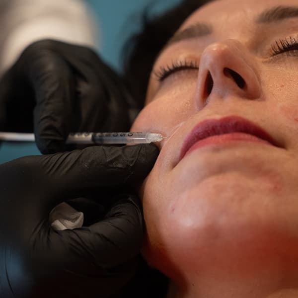cheek-filler-treatment