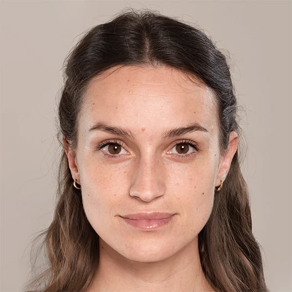 before-filler-sharon