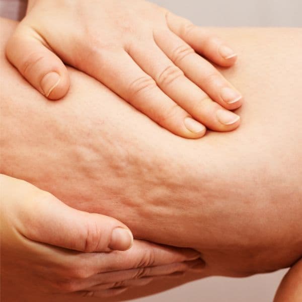 Cellulite-leg