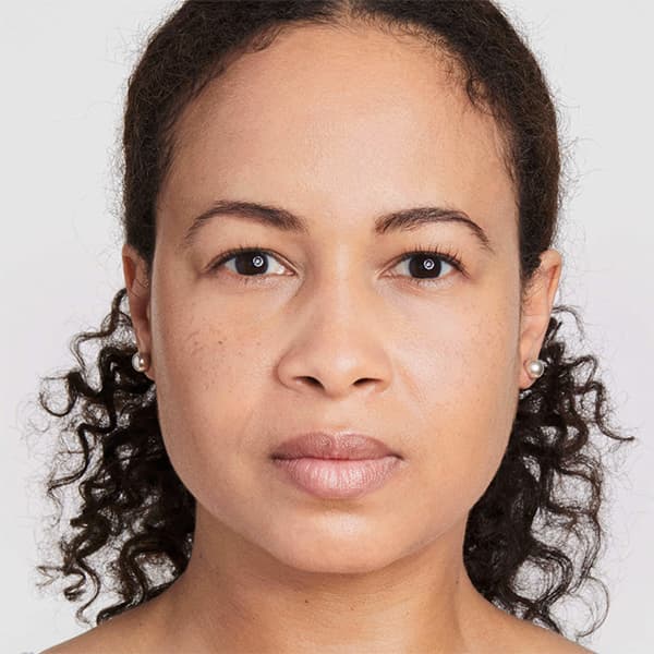 erin-before-treatment