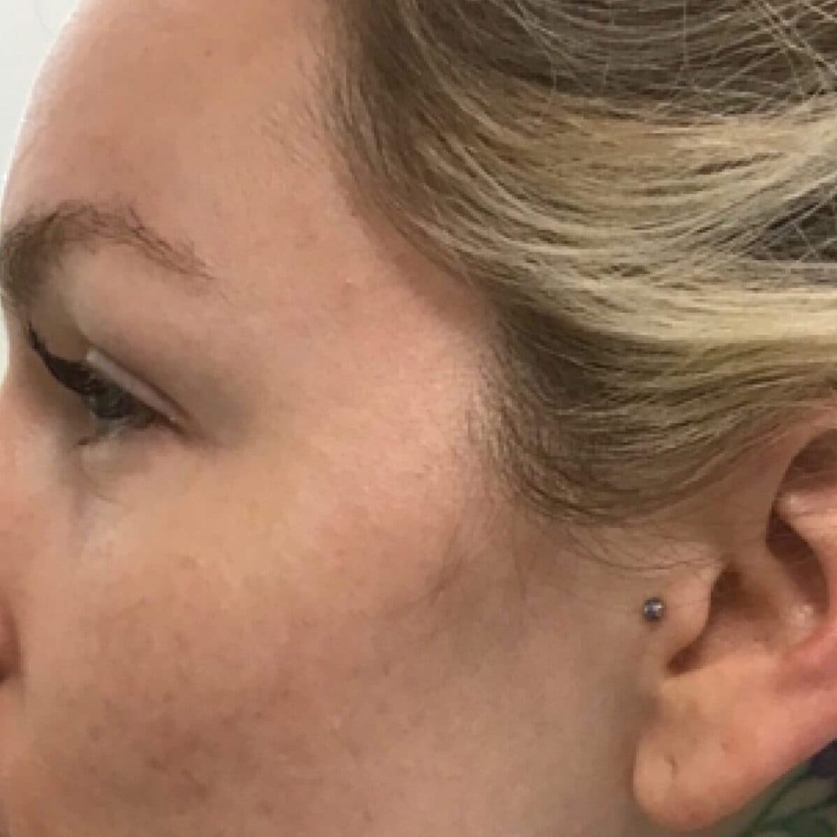 Acne scar treatment results showing smooth, clear skin on a woman's face at Cannelle Skin Clinic.