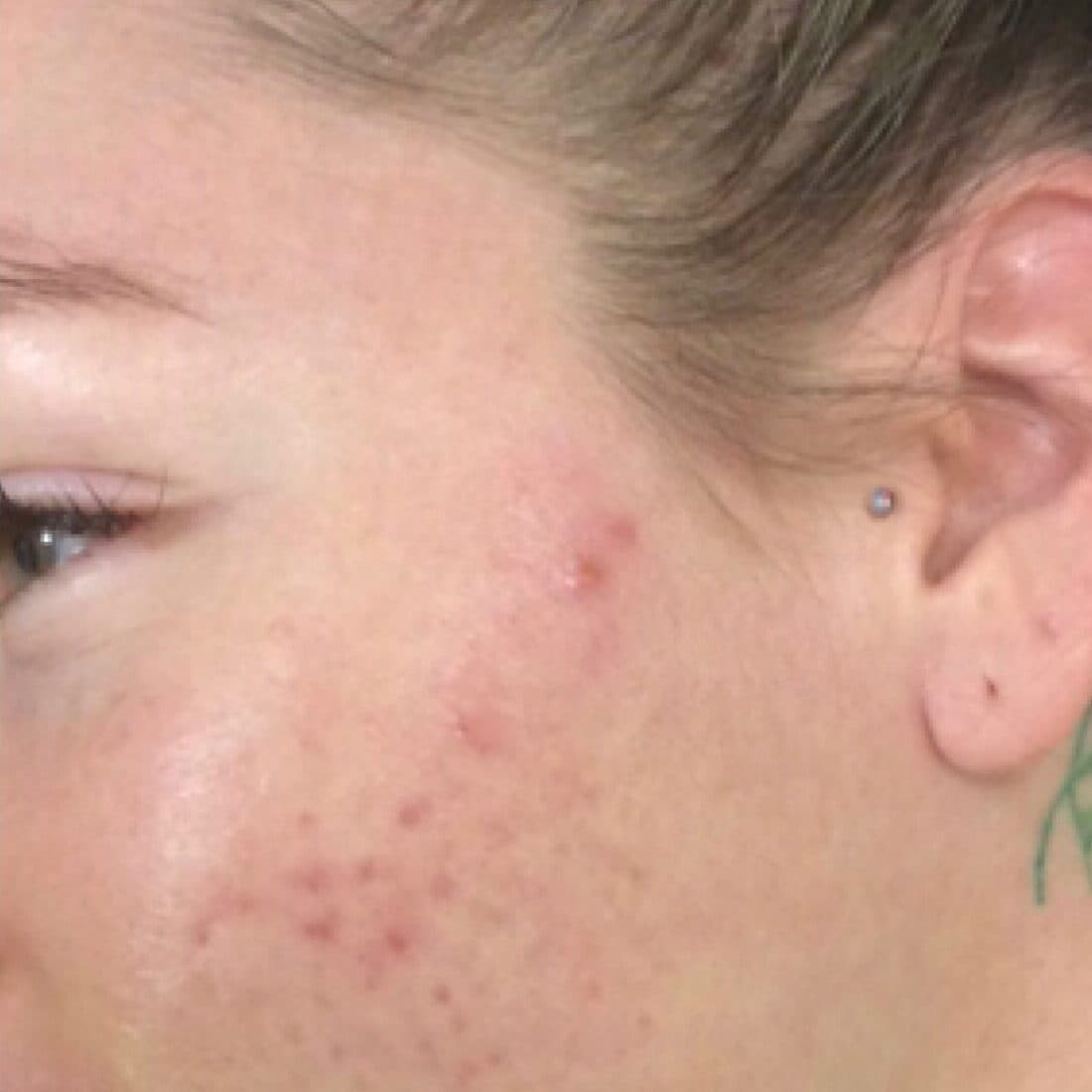 Close-up of a woman's cheek showing acne scars and skin texture.