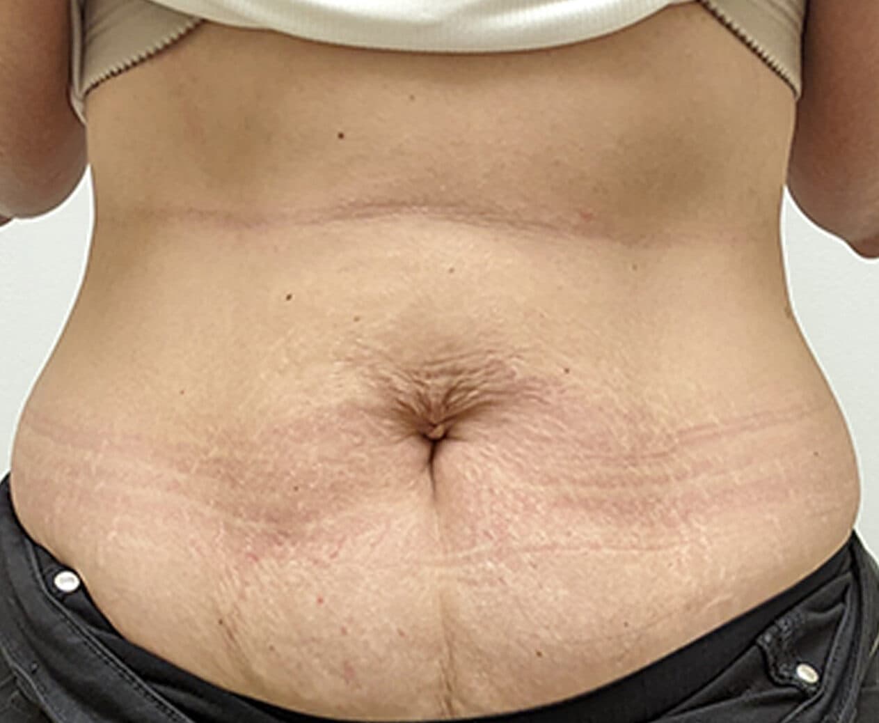 Morpheus 8 body after