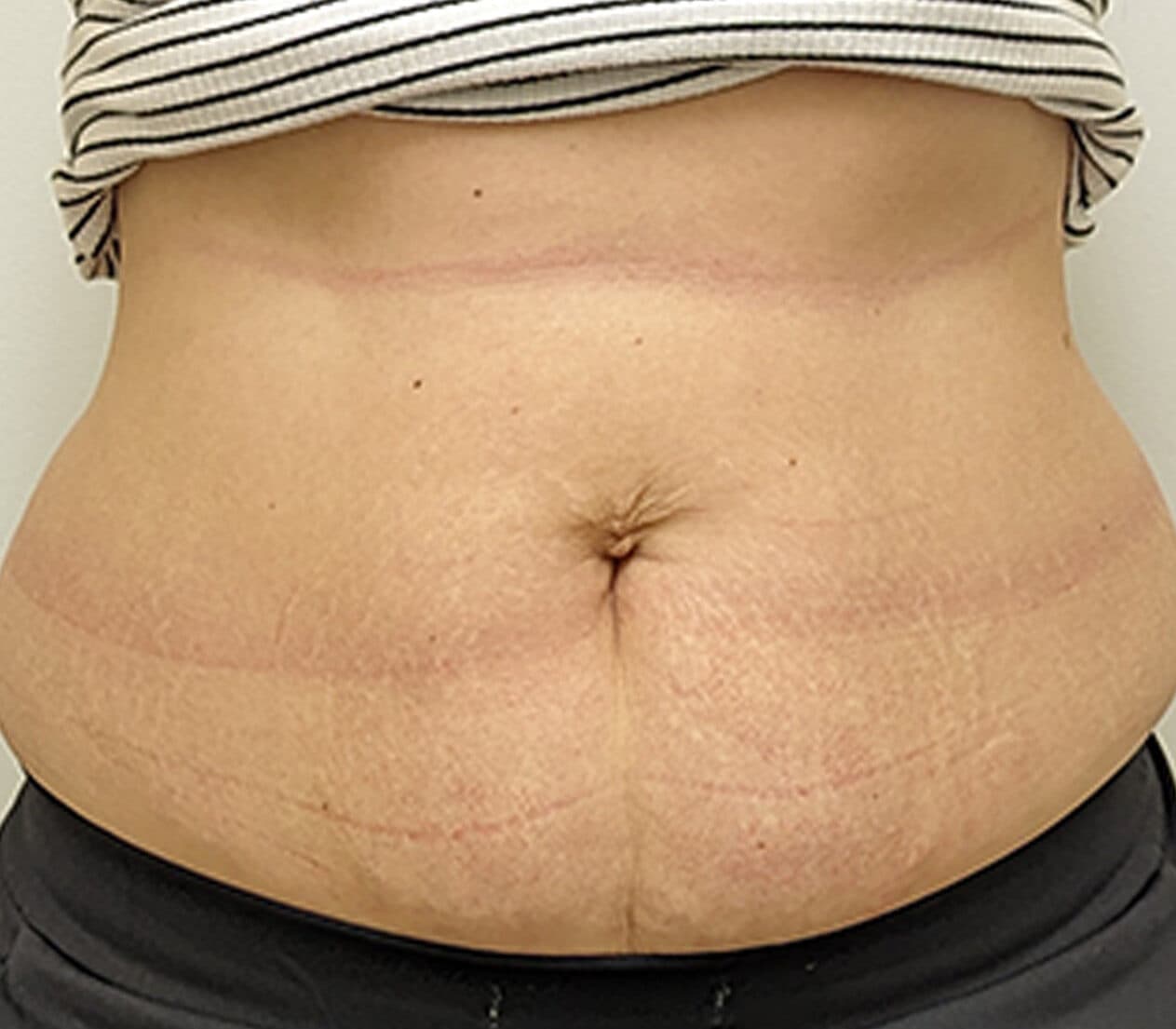 Morpheus 8 body before