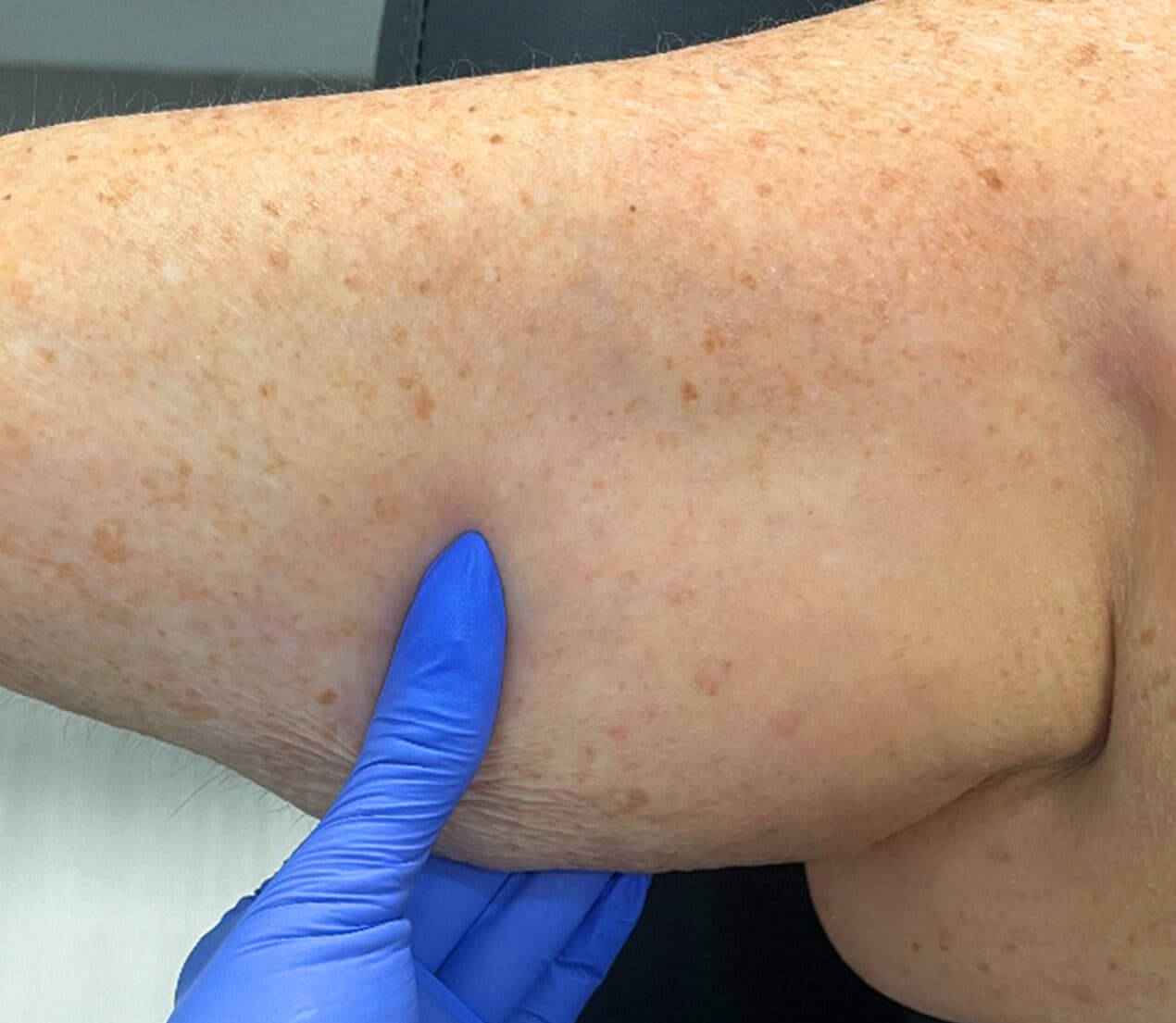 Morpheus 8 body before